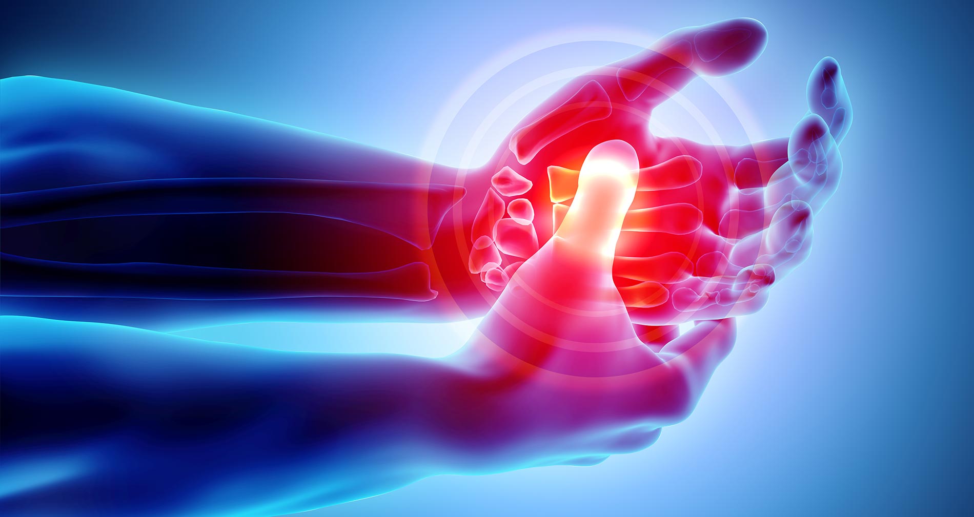 Image of hand with carpal tunnel syndrome pain